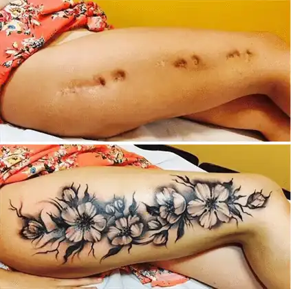 Tatuaggi di copertura delle cicatrici a Ibiza