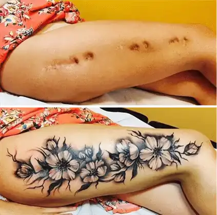 Litteken Cover-Up Tatoeages in Ibiza